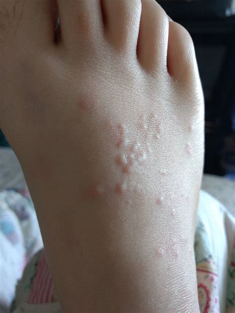 White Bumps On Baby Feet at Mike Lyles blog