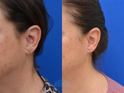 Earlobe Repair Before and After Pictures Case 88 | Charlotte, NC | Dilworth Facial Plastic Surgery