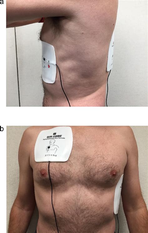 Anteroposterior pacer pad position is better than anterolateral for ...