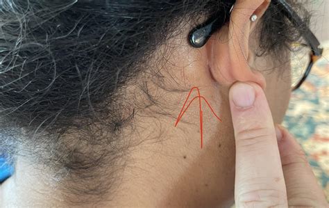 Hard lump behind both ears. : r/medical_advice