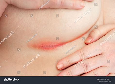 Patient Intertrigo Shows Erythematous Rash Skin Stock Photo 2512008291 ...