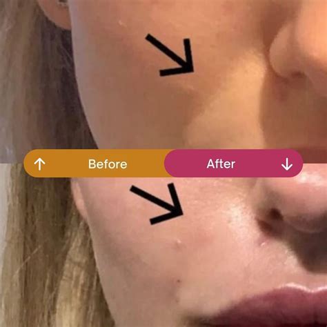 Nose to Mouth Lines: Can Botox Help Soften Smile Lines?