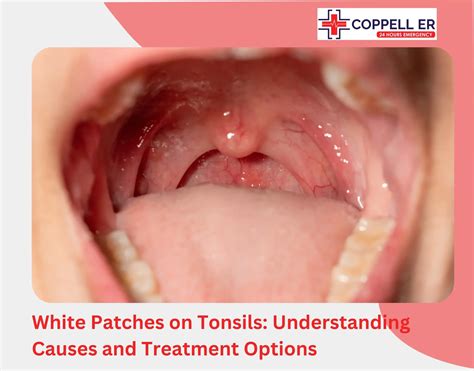 White Patches on Tonsils: See Causes and Treatment Options