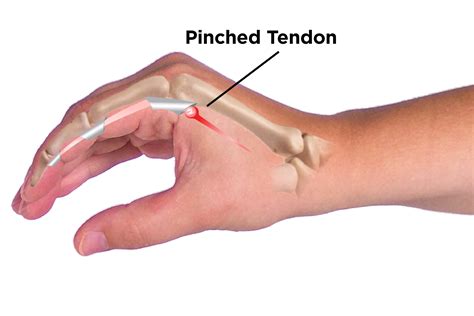 Index Finger Knuckle Pain When Bending at Otto Atkinson blog