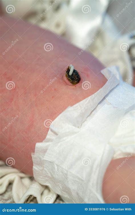 An Infants Umbilical Cord Stump is Carefully Cleaned with a Cotton Swab ...