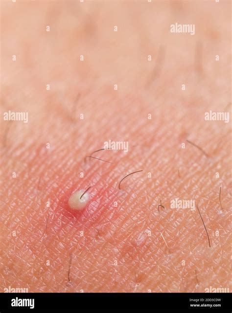Ingrown Hair Infection