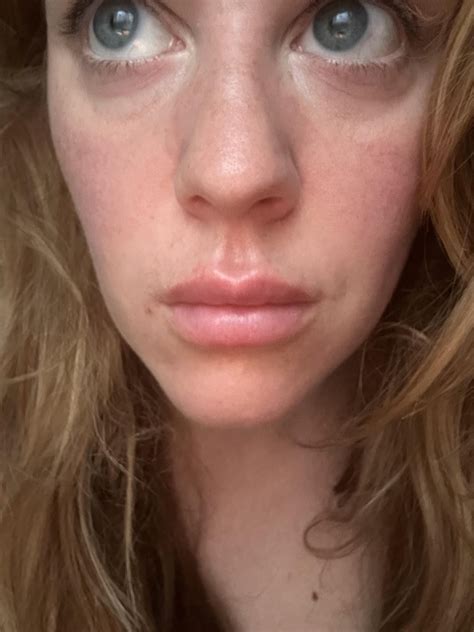 Rash on feet with unexplained severe body aches and swollen face : r/DiagnoseMe