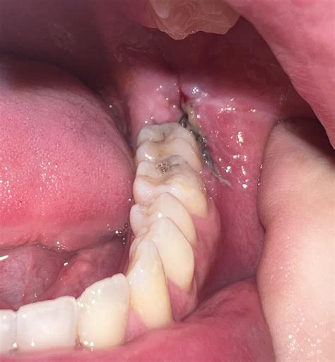 Osteomyelitis After Wisdom Tooth Removal at Dustin Richards blog