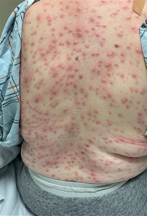 SYPHILIS : CAUSES , PREVENTION , RISK FACTORS