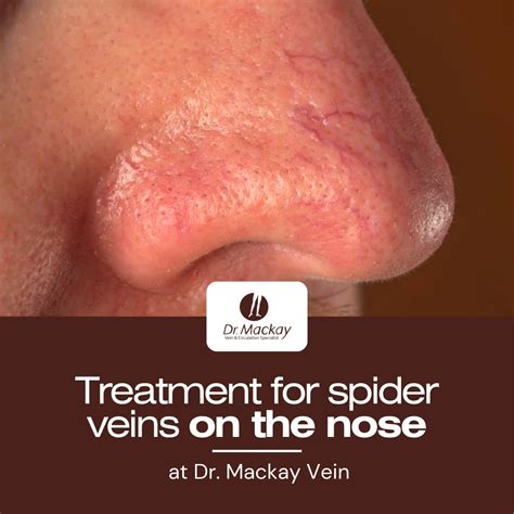 Spider Veins On Nose
