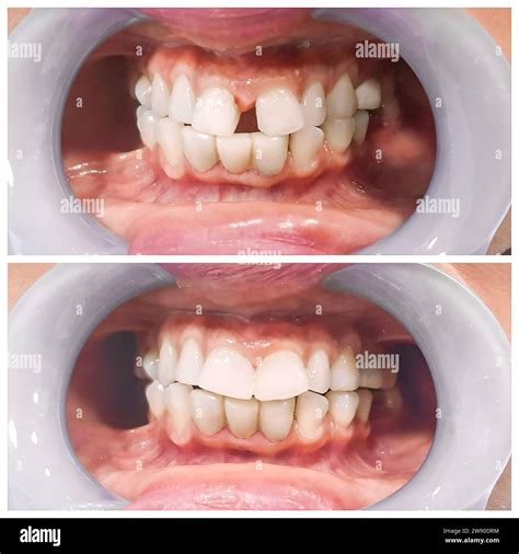 Gap Between Toddlers Front Teeth at Sebastian Bardon blog