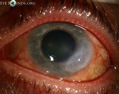 Marginal Ulcer Eye