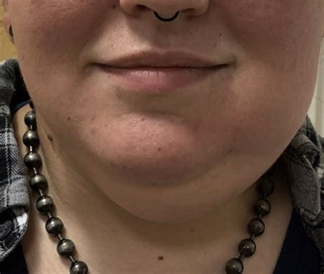 Woman With Unilateral Facial Swelling - Annals of Emergency Medicine