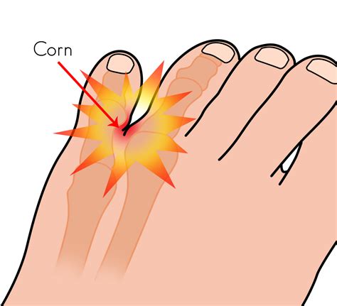 Corn Or Callus Between Toes at Asha Vang blog