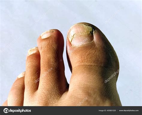 Toenail Fungus Peak Infection Painful Toe Contagious Onychomycosis ...