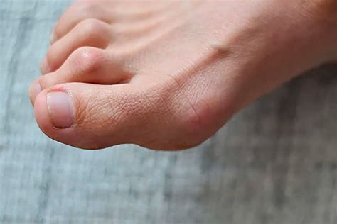 Hammertoe Correction without Surgery - The Foot Practice Podiatrist Singapore | Podiatry Clinic ...