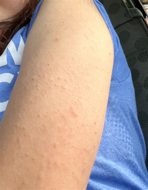 Keratosis Pilaris Bumps On Arms To Buy | www.pinnaxis.com