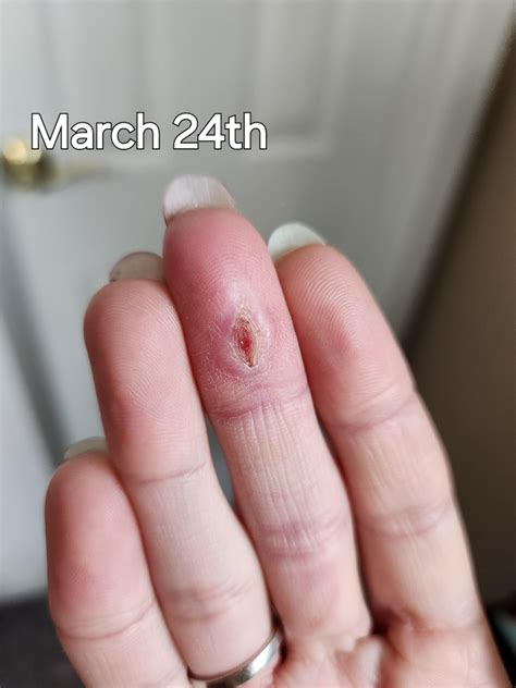 Infected cut on finger healing : r/medizzy