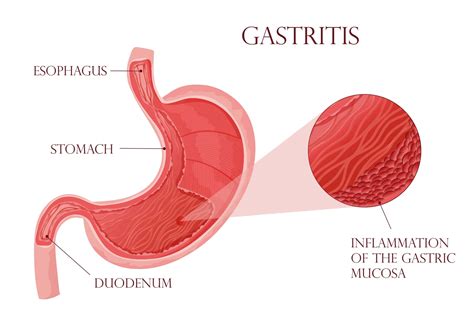 What Is Gastritis? Causes, Symptoms & Treatment | NextCare