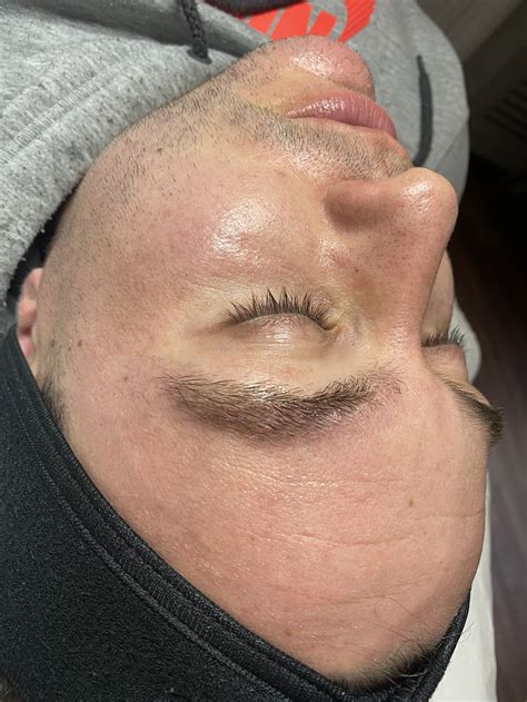 Glycolic Acid Peel — The Face Therapist