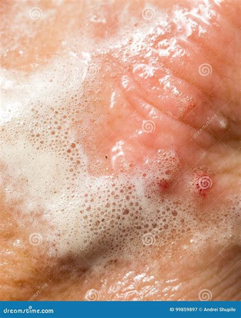 Blood on the Skin from a Cut in Hydrogen Peroxide Stock Image - Image of hydrogen, skin: 99859897