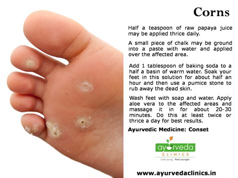 14 proven home remedies for corns callus removal that work – Artofit