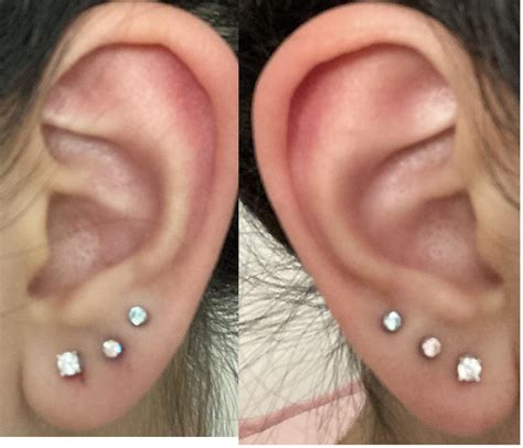 Messed up by not telling piercer that I had corrected an old first lobe ...
