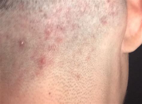 Red Bumps After Shaving