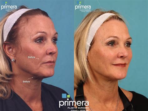 Face Fat Jowls at May Myers blog