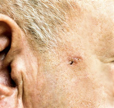 Squamous Cell Carcinoma | Skin Cancer | Bronx, NYC