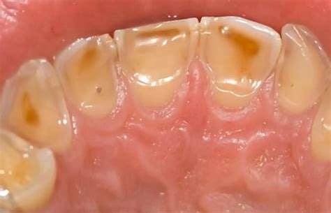 Dental Erosion Defect