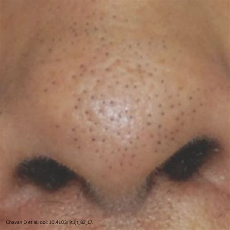 Black Spots on Nose: What Is Trichostasis Spinulosa? | Dr Raechele Derm