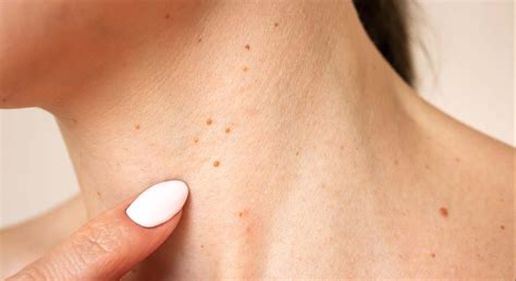 ¿Por qué salen verrugas en el cuello? Estos son los remedios caseros para quitarlas