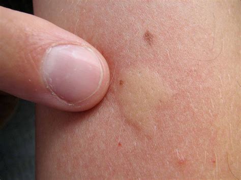 Learn About Mosquitoes and How to Prevent Their Bites