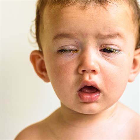 Eye Drops For Bacterial Conjunctivitis For Babies at Clemente Herrera blog