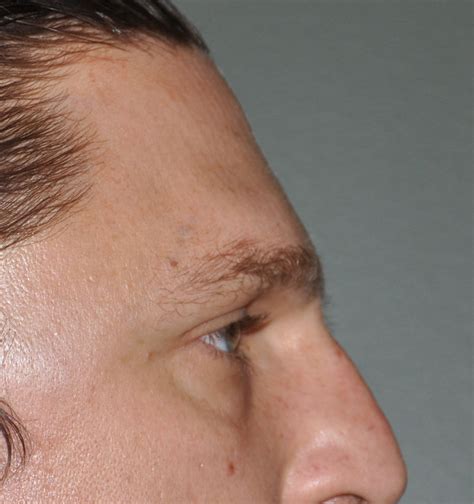 Forehead Brow Bone and Temporal Contouring