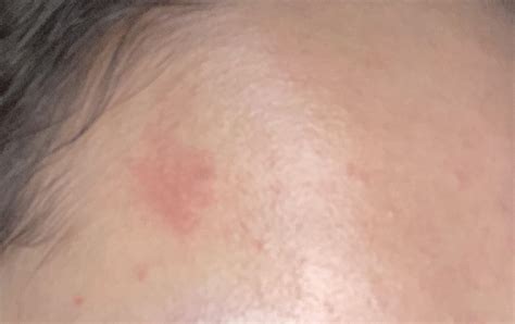 This red spot appeared on my face. Does anyone know what it is and how to get rid of it? : r ...