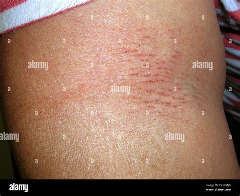 Staphylococcal scalded skin syndrome Stock Photo - Alamy