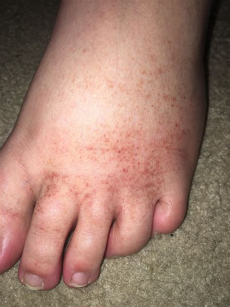 Why Do I Get White Spots On My Feet - Design Talk