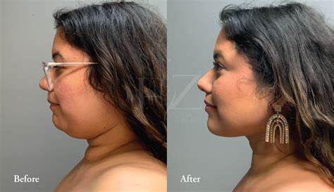 Chin Liposuction Before & After — HZ Plastic Surgery