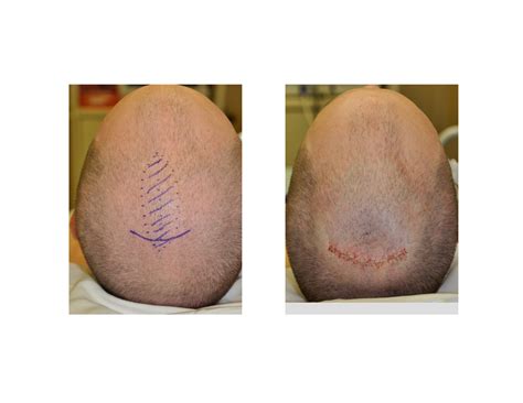 Sagittal Suture Ridge What You Need To Know About Craniosynostosis In