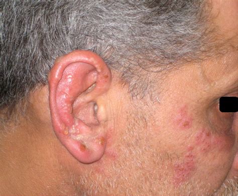 Disseminated primary HSV-2 infection of the face