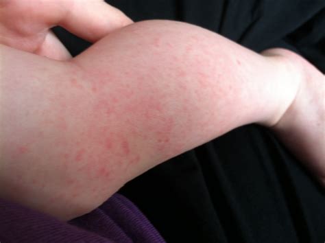 Motherly Musings: Hand, Foot and Mouth Disease