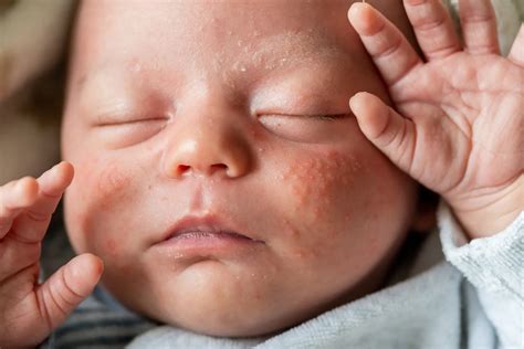 Baby Acne | LifeMD