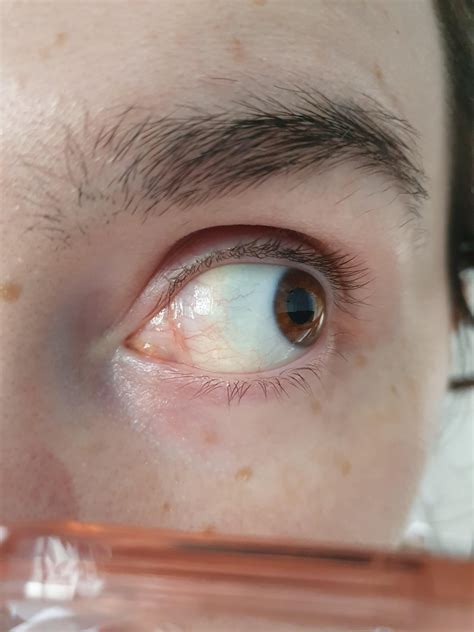 Inner corner of eye looking yellow and irritated : r/DiagnoseMe