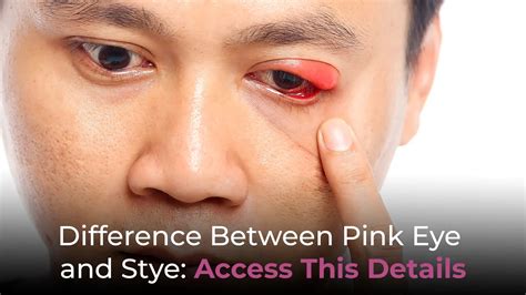 Know The Difference Between Pink Eye and Stye