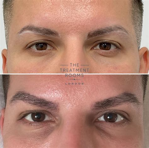 Eyebrow Hair Transplant Surgery | Treatment Rooms London