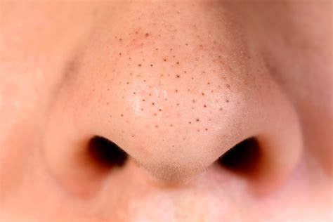 Blackheads: the best and worst ways to remove them