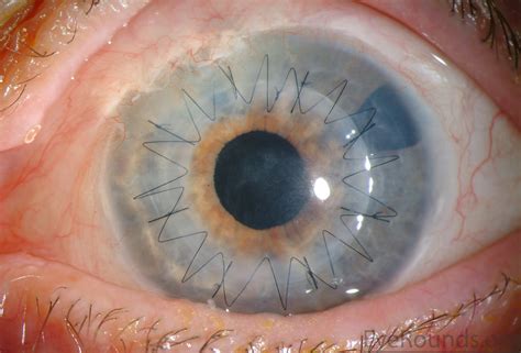 Corneal Transplant Stitches