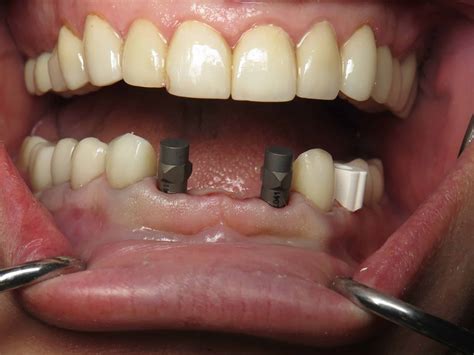 Dental Bridge Front Teeth